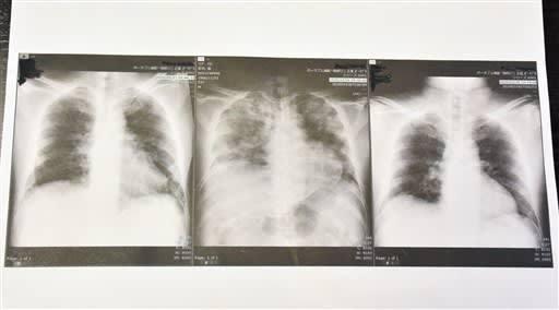 日本 胸片,揭秘胸片背后的健康奧秘